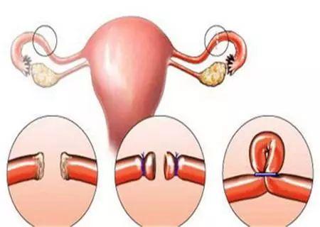 产后什么时候结扎好呢？#清风计划##健康早班车#