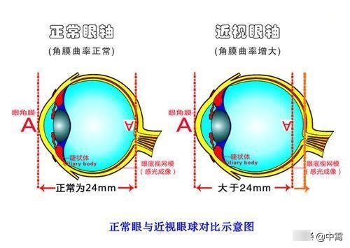 孩子近视与用眼过度无关，重点是要有户外活动