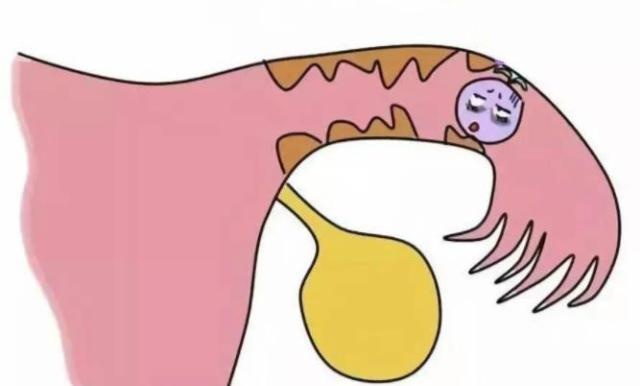 输卵管不通，多数和这3个原因有关，若你正在备孕，对照自查一下