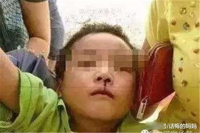 孩子流鼻血，“仰头”到底是对是错？宝妈们切忌别再这样做了