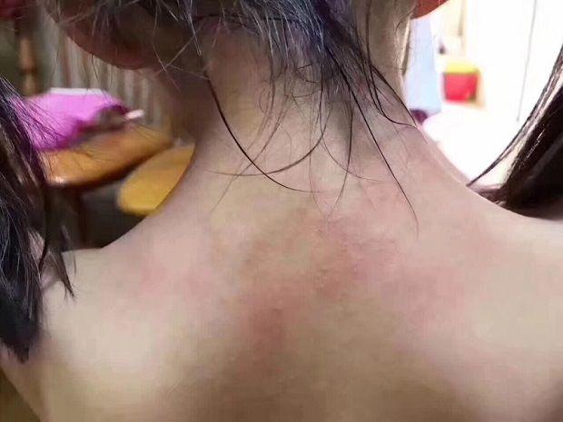 幼儿园小班，一多半孩子都长了痱子，老师推卸：空调开得很足