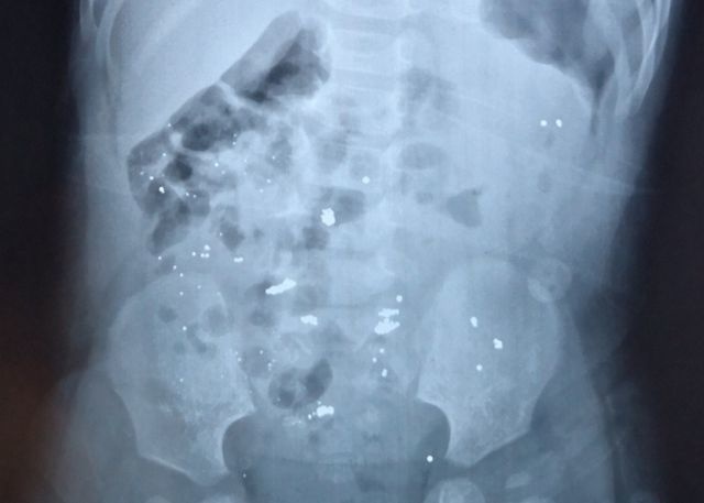 孩子误食水银怎么办？这位妈妈的做法，获得医生点赞！