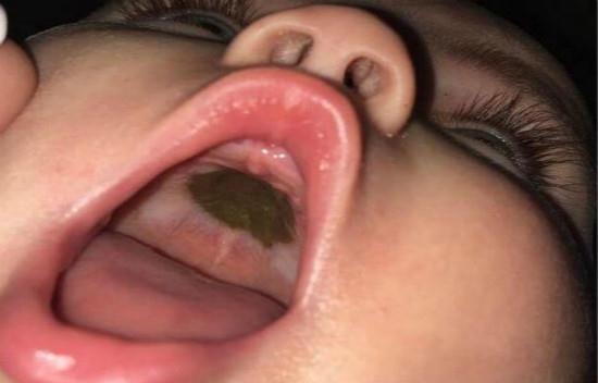 女婴上颚突现巨大黑斑，宝妈急忙带去就诊，结果让大家笑趴