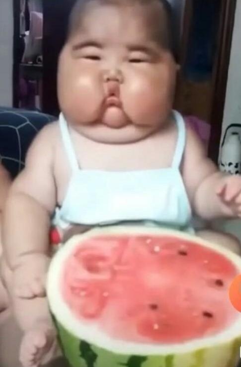 误以为是孩子肥胖！其实是一种少见的疾病：新生儿束带综合症