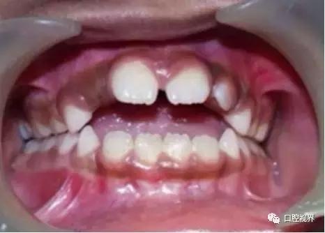 父母必看！不良口腔习惯对孩子牙齿和面部的影响竟然有这么大