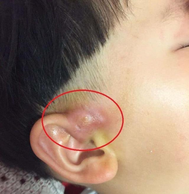 宝宝耳朵上有个小洞，老人说孩子有福气，医生的话让妈妈吓了一跳