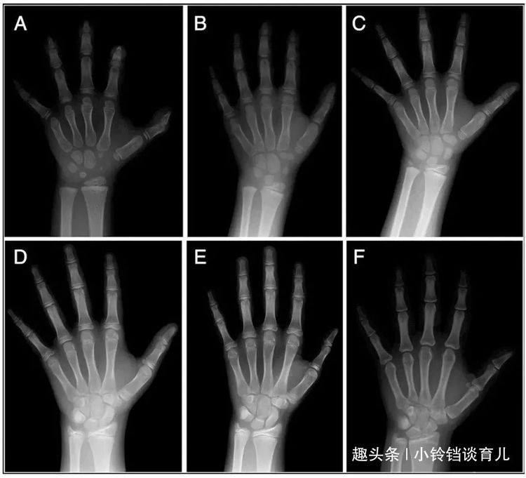 10岁男孩暑假“听”成性早熟，只能长到1米6，育儿路上满是地雷