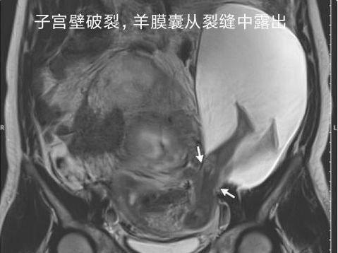二胎怀孕7个月，子宫被胎儿一脚“踢破”，医生检查后怒斥无知