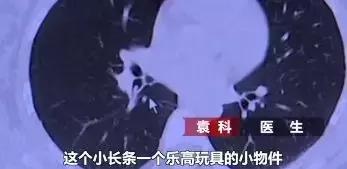 这个小玩具，差点要了母女俩的命！很多孩子手里都有它
