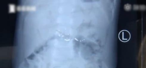 不要让孩子离开自己的视线！危险，2岁男童误吞体温计内水银