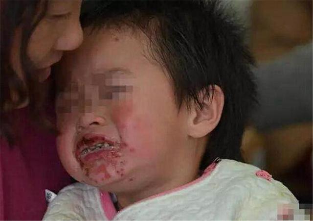 5岁男孩偷吃大人零食，1年后已是癌晚期，父母后悔来不及