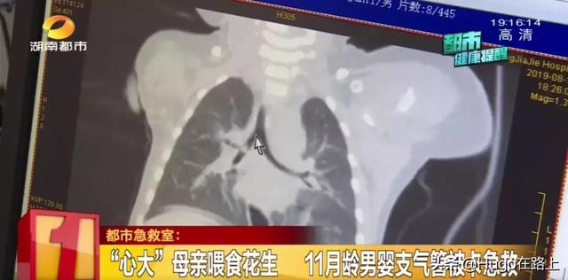 母亲将咬碎食物放到11个月孩子嘴里！孩子差点没了命！无知啊