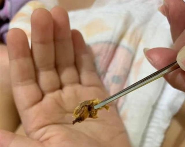 妈妈夹出大块耳屎 4岁儿听力变好
