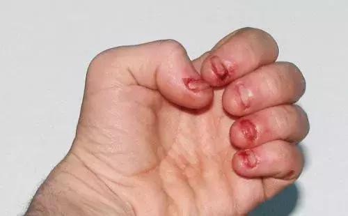孩子总是啃指甲怎么办？别忽视！小心拖成大问题