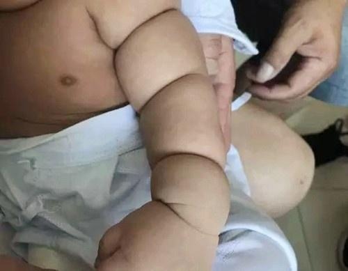 3个月宝宝胖嘟嘟，手脚像一节节莲藕，医生检查后却说要截肢