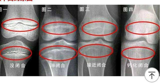 妈妈常给闺女吃这种食物，让9岁女儿2年没长个，骨骺线也提前闭合
