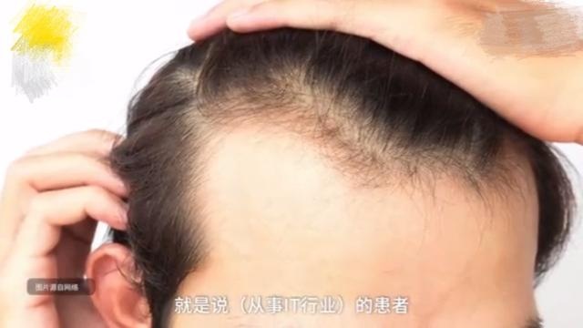 脱发人群越来越“年轻”！因为学习压力大，13岁少女头发几乎脱光