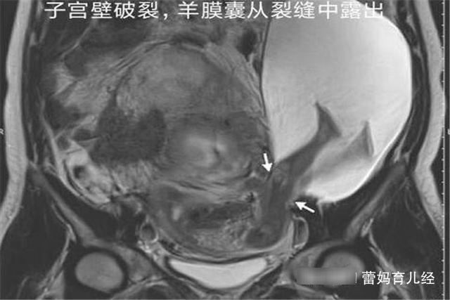 女子怀孕7个月，子宫意外被胎儿“蹬破”，她却求大夫保小的？