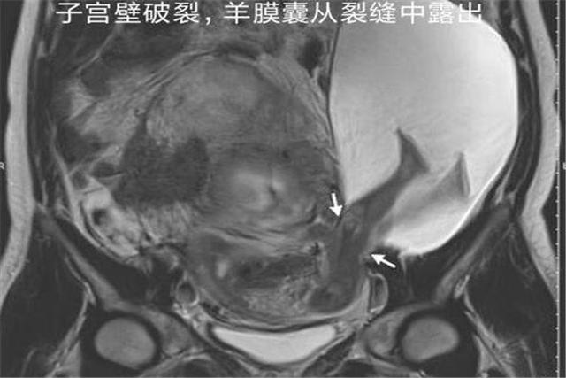 女子怀孕7个月，子宫意外被胎儿“蹬破”，婆婆却求医生保小的？