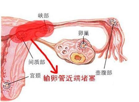 输卵管通而不畅？还可能怀孕吗？