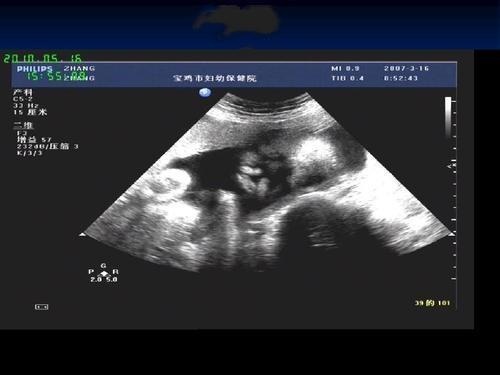 孕检胎儿畸形，检查结果出来，宝爸责怪自己：早知道不那样做了