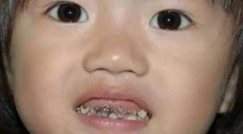 孩子不吃糖，牙怎么也会这样啊！