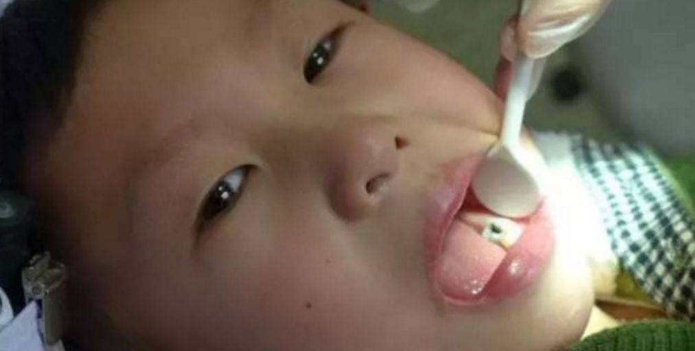 孩子不吃糖，牙怎么也会这样啊！
