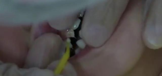 宝宝不到两岁，乳牙就坏了四颗，只因喂奶时没这样做