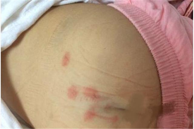 孩子身上长出“红点”，妈妈随手用痱子粉擦，一周后却流血化脓？