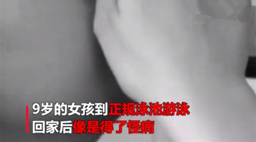 九岁女孩泳池游泳后常流鼻血，医生检查后，发现鼻子里竟钻进蚂蝗