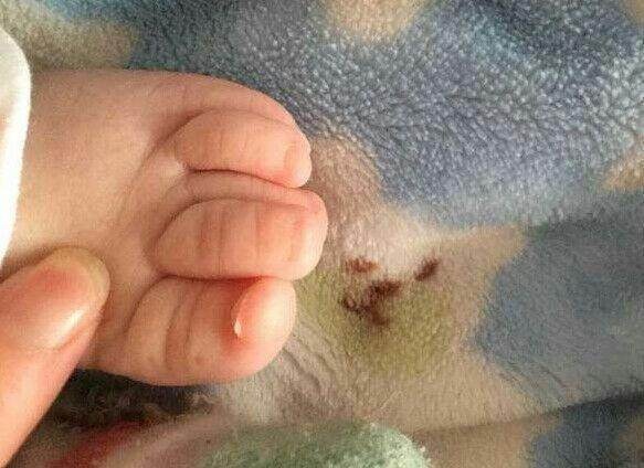 新生儿脚趾不对劲，医生说用力掰回来，妈妈不淡定