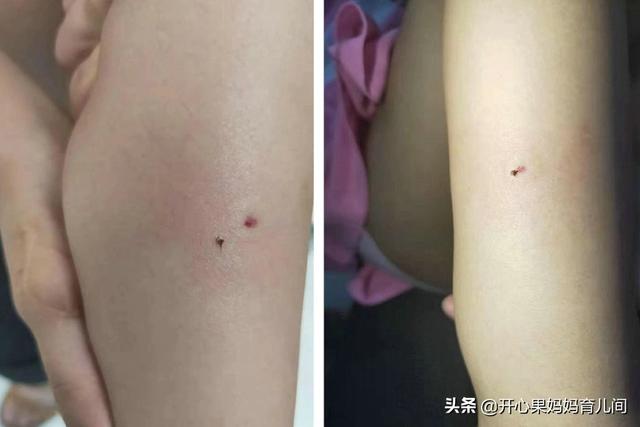 3岁女孩被&quot;刺&quot;，妈妈的做法获医生称赞：是你救了自己女儿