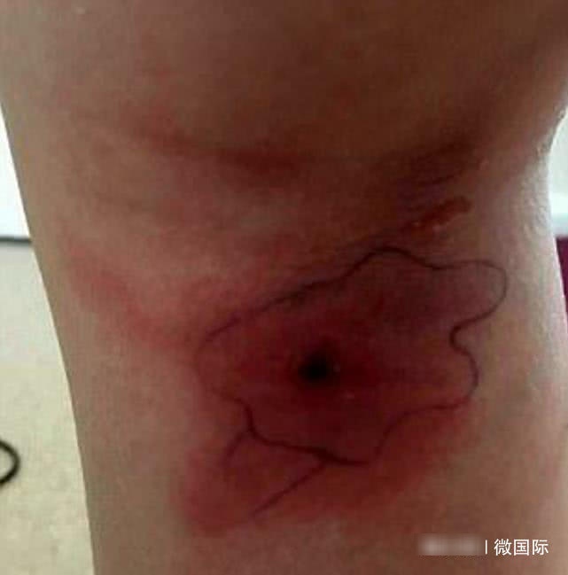小女孩被蜘蛛咬了一口，回家高烧不退，从脓包里爆出一堆蜘蛛