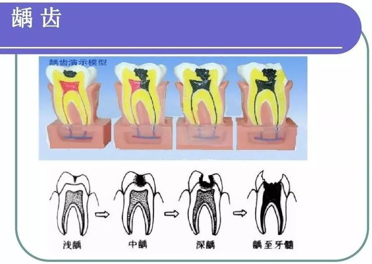 新手爸妈注意：宝宝牙齿健康不可忽略，龋病的预防要做到这3点！