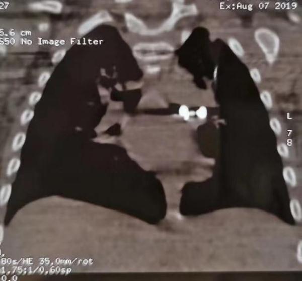 9月大女婴呼吸困难，拍片发现亮晶晶物体，竟是妈妈……
