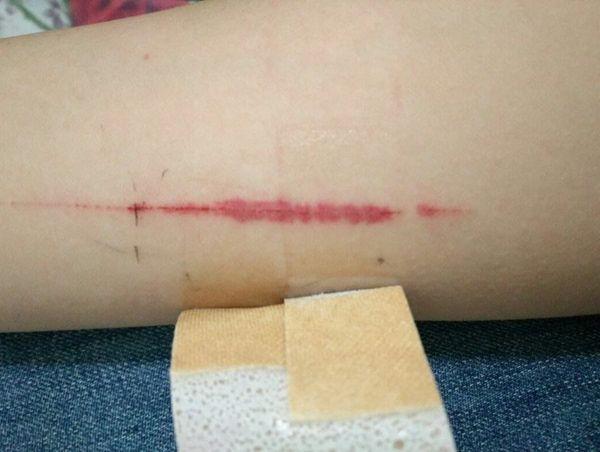 宝宝脚底长“黑虫”？家长急匆匆带孩子去医院，检查后吓了一跳