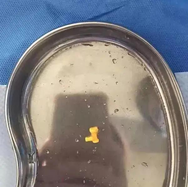 女童误吞玩具，宝妈做法反把自己送医院，如何正确应对，家长速学