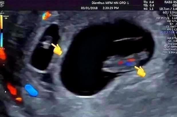怀孕之后再怀孕，一个孕8周，一个孕6周，这是什么神仙操作？