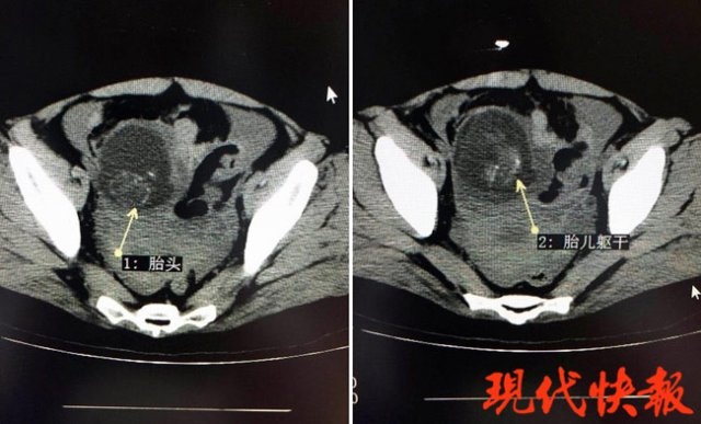 概率1/15000！孕妇被查出“腹腔妊娠”，宝宝滑进妈妈肚子