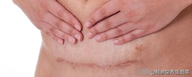 剖腹产怎样减肥 宝宝6个月后再考虑