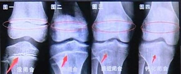 14岁男孩只有160cm，医生：这个习惯是“身高杀手”，家长别再犯