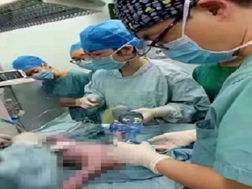 女子产检怀连体婴儿拒绝引产，孩子出生后，全家人乐开了花