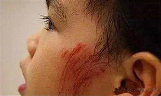 孩子脸被树枝划伤，妈妈涂上芦荟“万能胶”，差点给孩子毁容