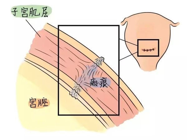 孕妈妈一胎剖腹产，生二胎再次剖腹产的概率大，临产前3点要警惕