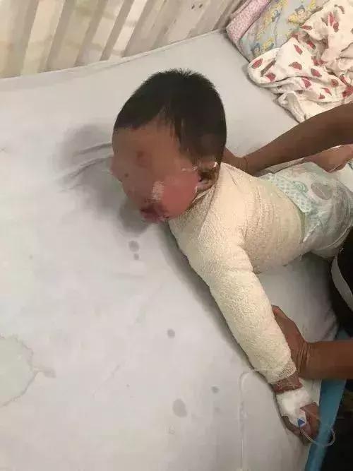 孩子不小心被热水烫伤，怎么办？在线等急