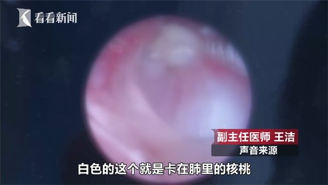 两岁男童咳嗽不止 医院拍片一看母亲吓到腿软