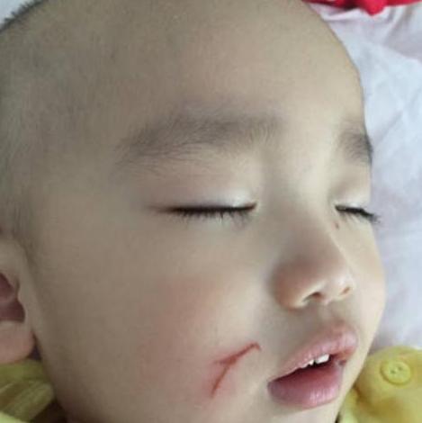 女儿在幼儿园被划伤脸，园长的做法，让妈妈忍无可忍