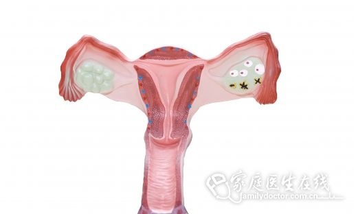 子宫憩室是什么意思？能考虑备孕吗？