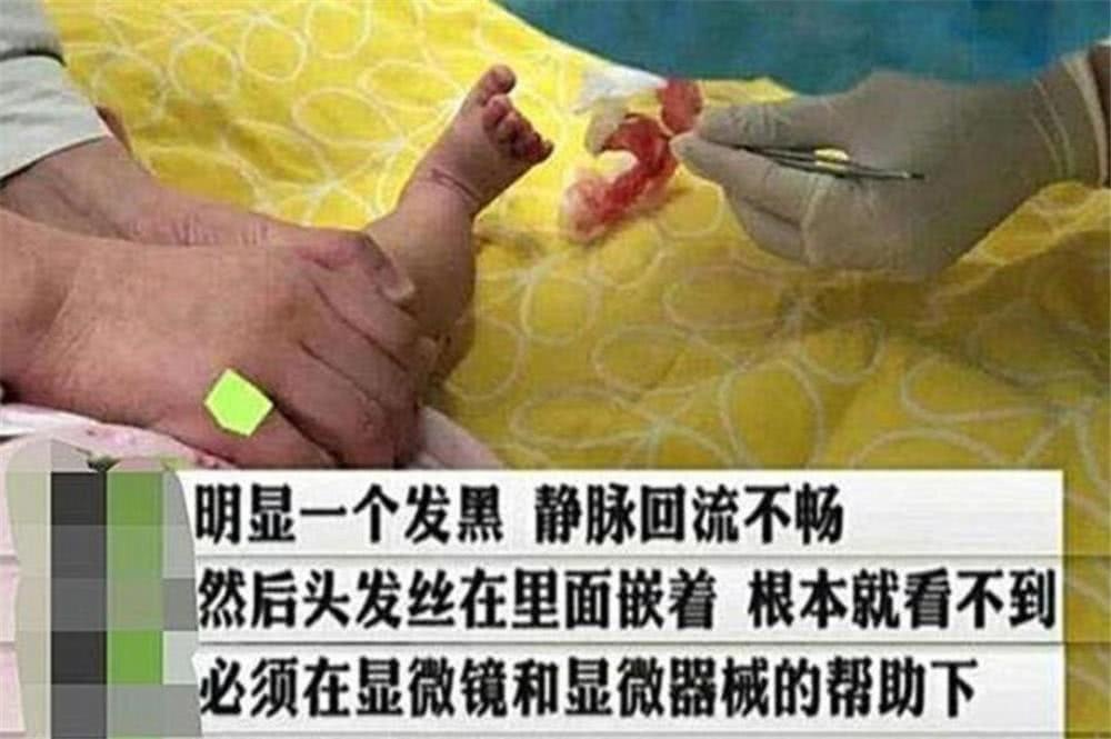 宝宝脚趾被“虫子”缠绕，妈妈赶紧带孩子检查，医生：幸好来得早