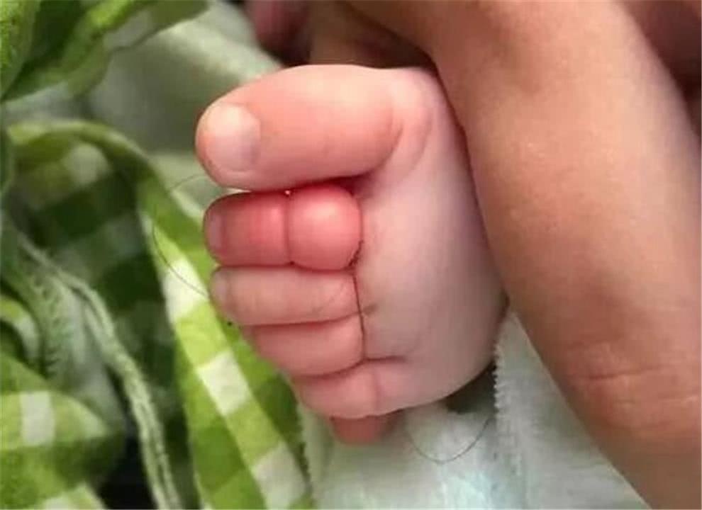宝宝脚趾被“虫子”缠绕，妈妈赶紧带孩子检查，医生：幸好来得早